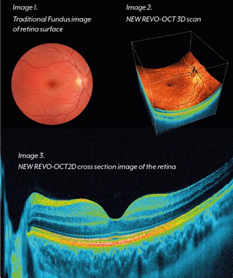 my oct test for thickness was 0.78|does oct reduce retinal thickness.